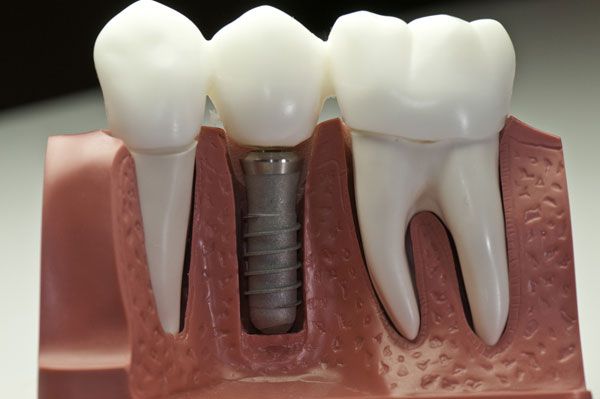 Искусственный зуб и имплантат изготавливаются из высококачественных материалов