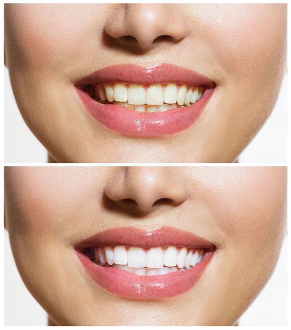 Метод отбеливания зависит от состояний зубов и индивидуальных особенностей пациента