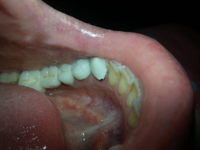Как проверить, правильно ли вам установили зубную коронку?