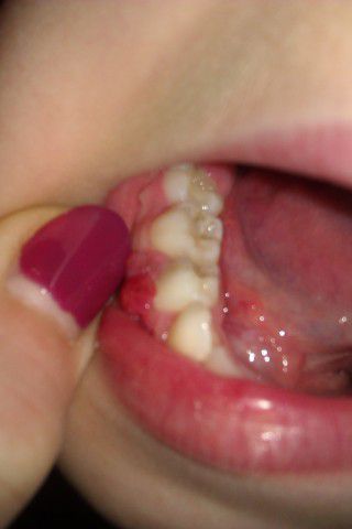 Шишка на десне: что это такое, причины и лечение — Экспертные статьи на сайте стоматологии АРТ