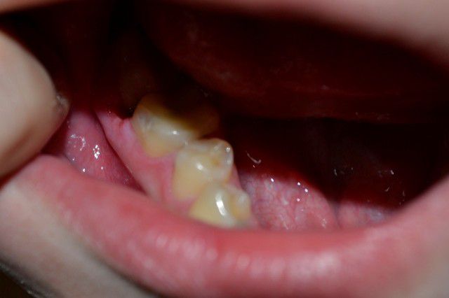 Отек щеки после лечения зуба: причины и способы лечения