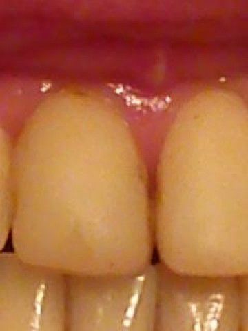 Флюороз зубов