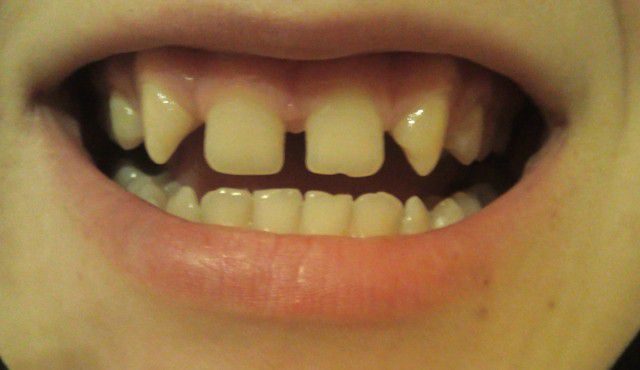 Адентия зубов у детей