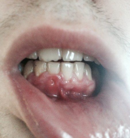 Что делать при появлении дырки в зубе?