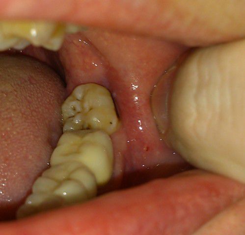 Черный налет на зубах: методы лечения
